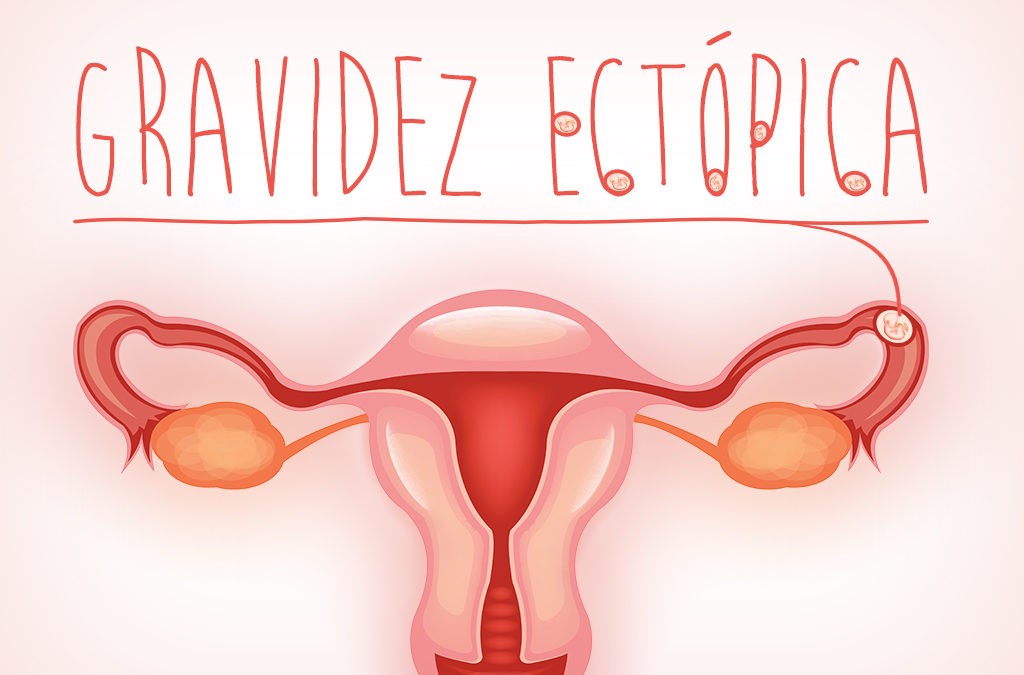 Tratamento hormonal para a gravidez ectópica
