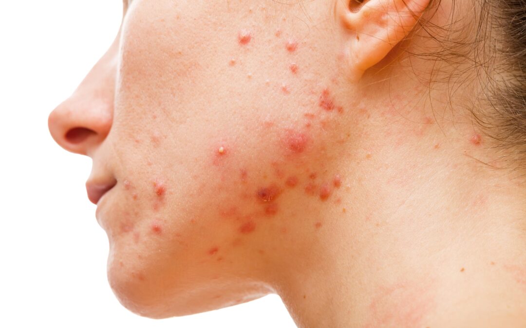 Acne persistente nem sempre é só dermatológica: quando a pele pode estar falando sobre hormônios, SOP e fertilidade